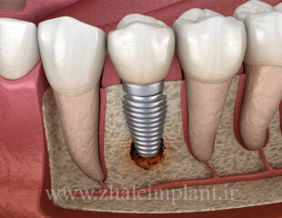 عوارض ایمپلنت دندان