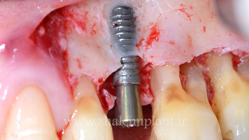 آسیب بافتی در ایمپلنت
