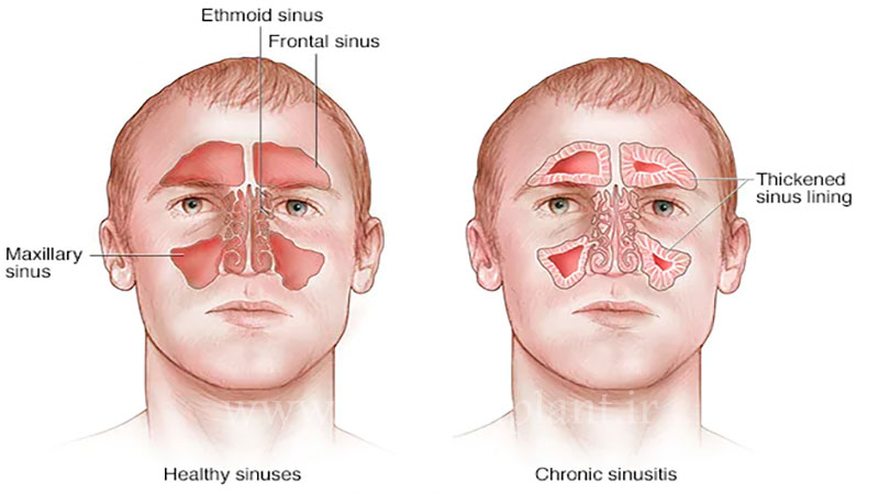 آسیب به سینوس‌ ها
