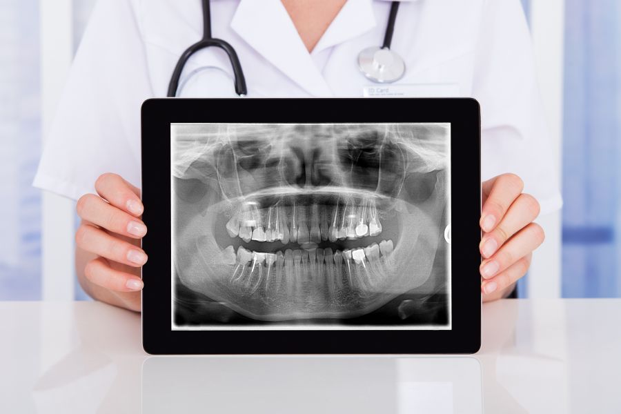  عکس x-ray از دندان