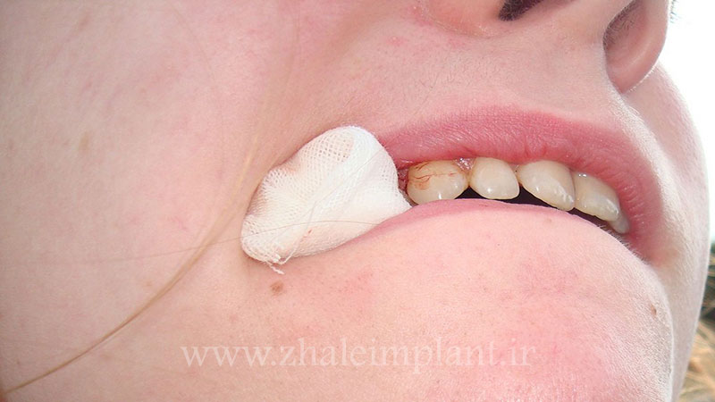 مراقبت های بعد از ایمپلنت دندان
