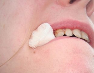 مراقبت های بعد از کاشت ایمپلنت دندان