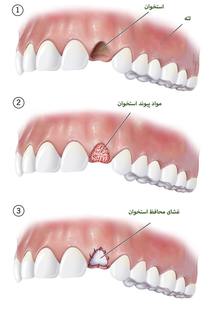 مراحل پیوند استخوان فک قبل از کاشت ایمپلنت دندان