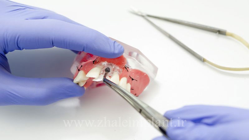 مراقبت از ایمپلنت دندان پس از جراحی