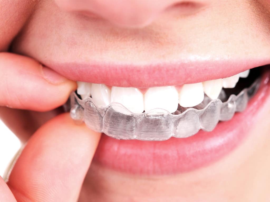 ارتودنسی نامرئی اینویزلاین