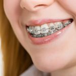 درمان ارتودنسی دندان