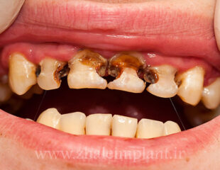 پوسیدگی دندان