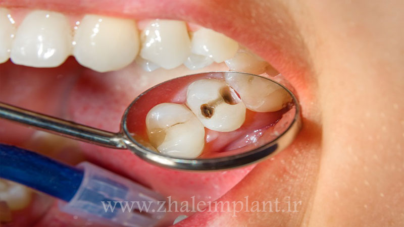انواع بیماری های دهان و دندان