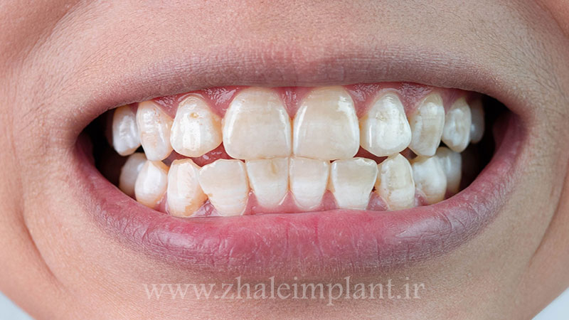 لکه سفید روی دندان