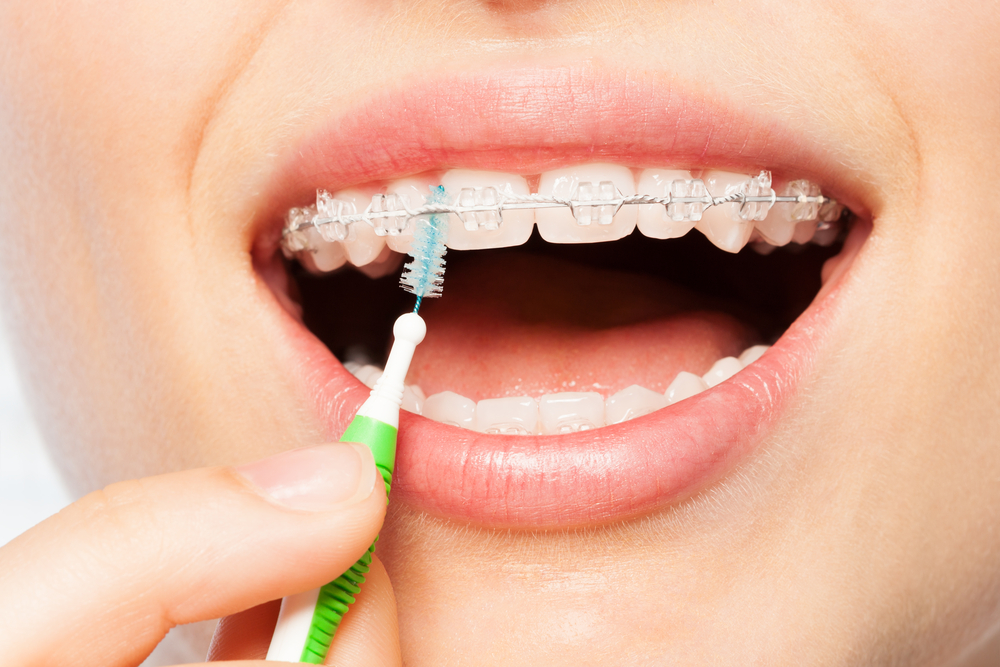 تمیز کردن ارتودنسی سرامیکی با مسواک بین دندانی