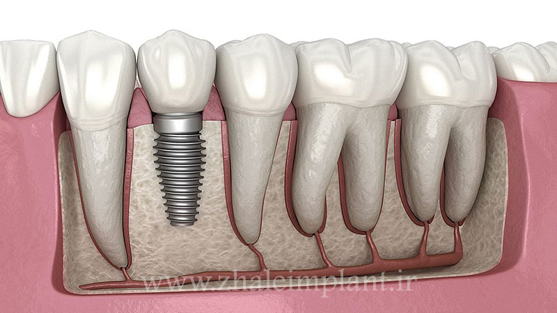 درمان ایمپلنت