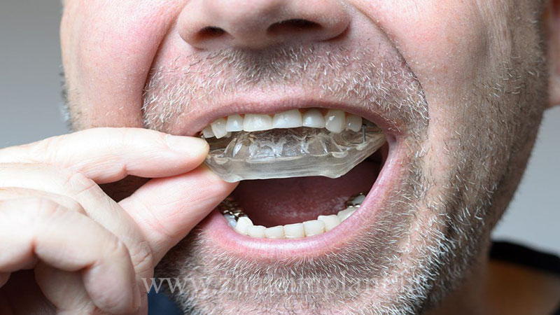 جلوگیری از قروچه کردن دندان