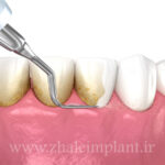 هزینه جرمگیری دندان