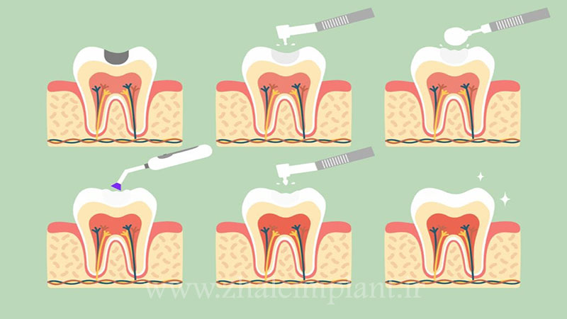 مراحل پر کردن دندان