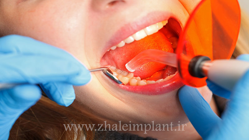 انواع مواد پر‌کردنی دندان