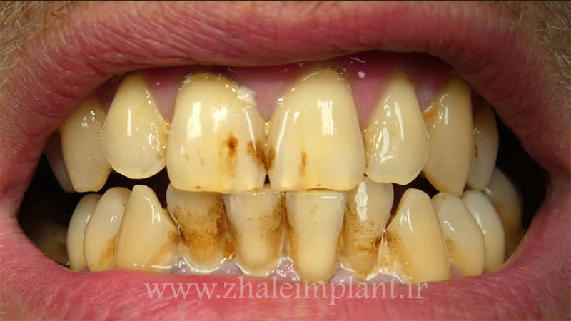 بیماری های جانبی دهان و دندان