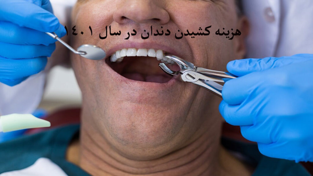 هزینه کشیدن دندان