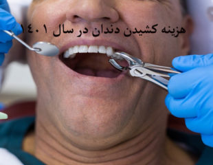 هزینه کشیدن دندان