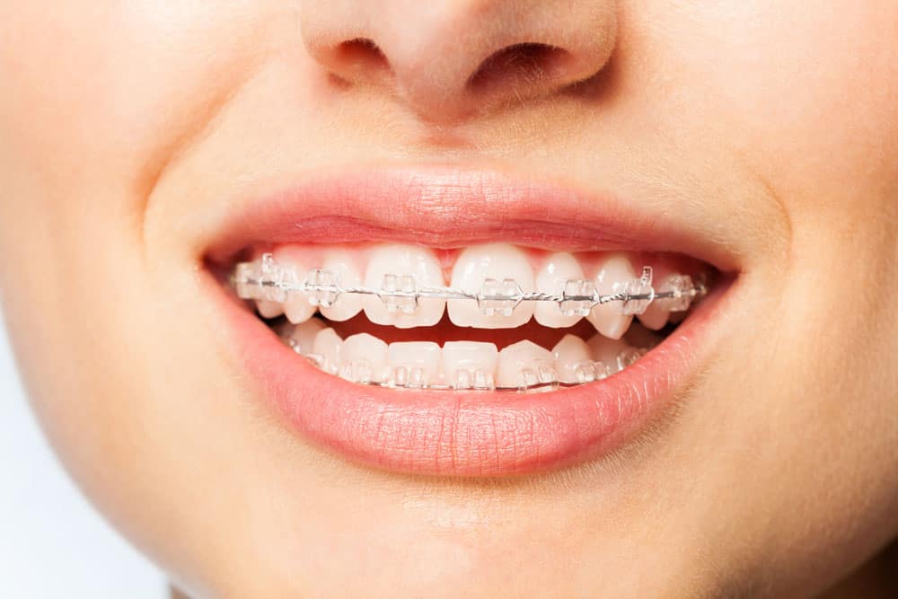 ارتودنسی سرامیکی شفاف