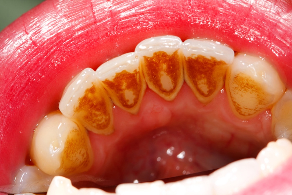 انواع جرم دندان