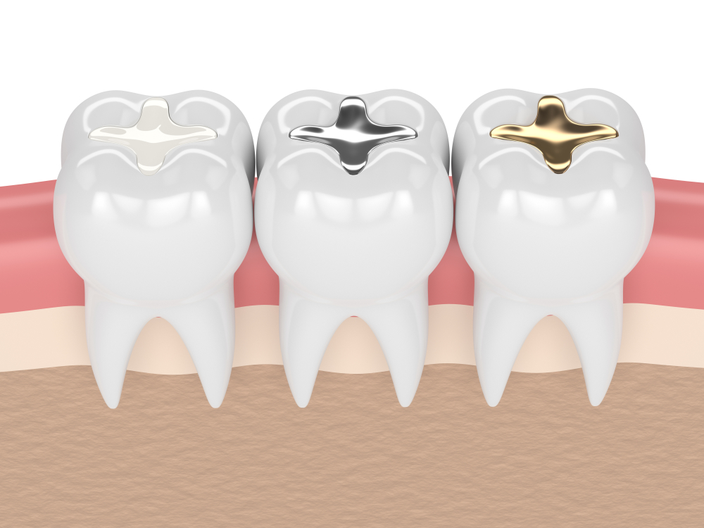 انواع مواد پر کننده دندان
