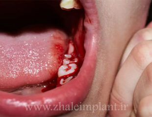 خونریزی بعد از کشیدن دندان