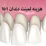 هزینه لمینت دندان