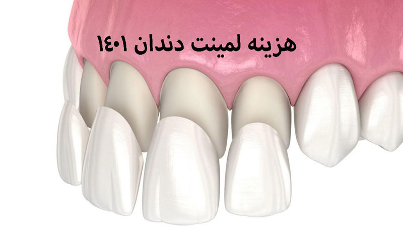 هزینه لمینت دندان