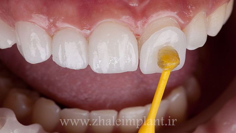 فرایند نصب ونیر کامپوزیت روی دندان
