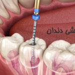 عصب کشی دندان