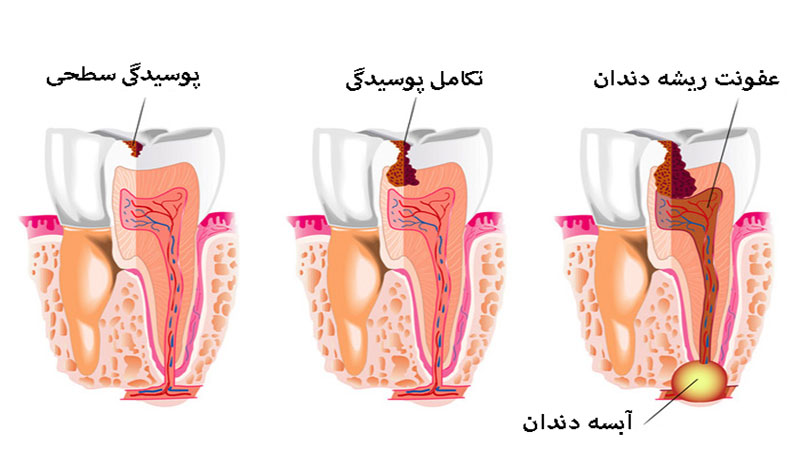 علت ایجاد آبسه