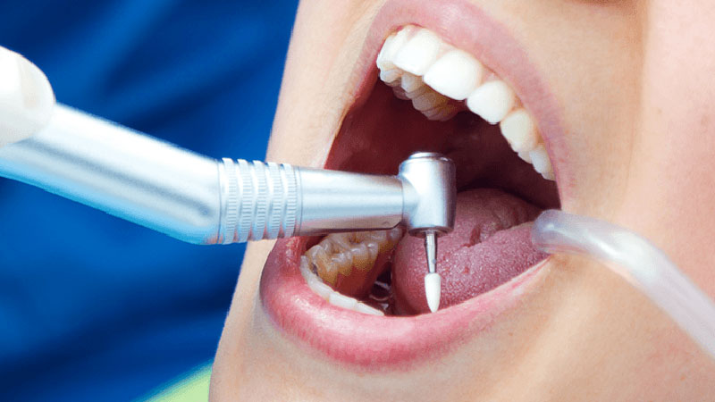 درمان ریشه دندان چقدر طول میکشد