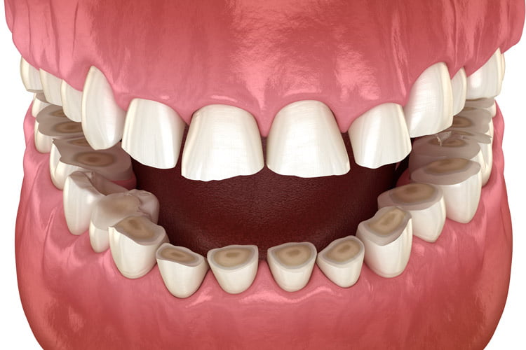 فرسایش مینای دندان در اثر دندان قروچه