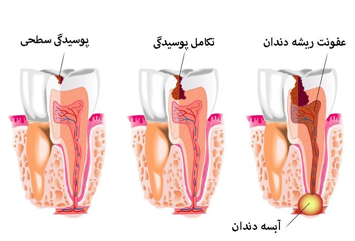 علت ایجاد آبسه دندان