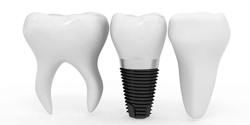 کیفیت اجزاء ایمپلنت دندان