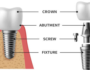 اجزاء ایمپلنت دندان