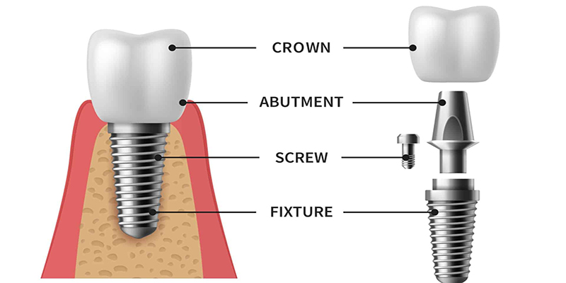 اجزاء ایمپلنت دندان