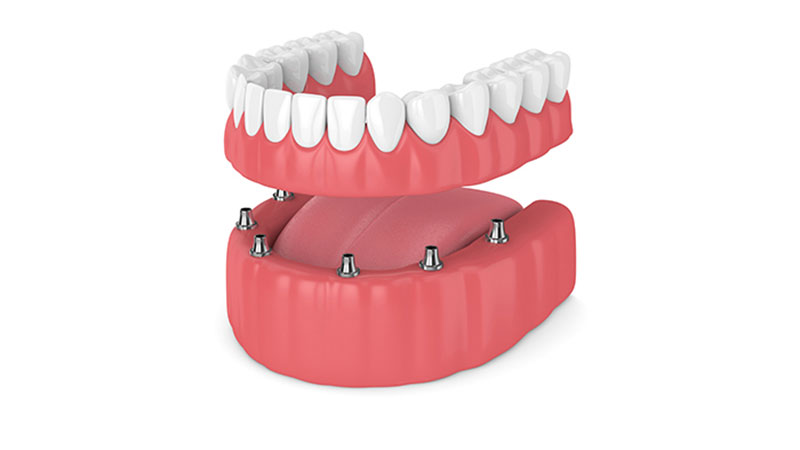 هزینه دندان مصنوعی بر پایه ایمپلنت