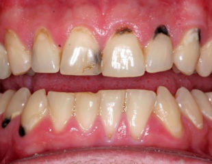 آیا لمینت دندان باعث پوسیدگی دندان می شود