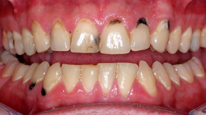 آیا لمینت دندان باعث پوسیدگی دندان می شود