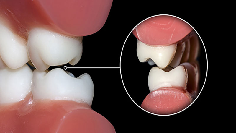دندان قروچه شدید یا طولانی مدت