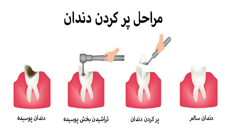 مراحل پر کردن دندان