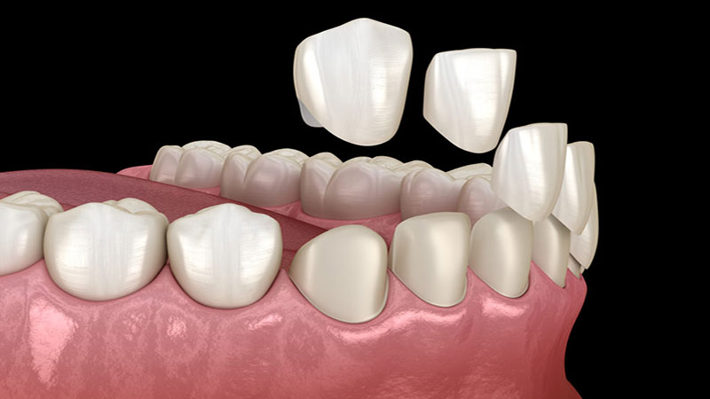 قیمت لومینیرز دندان