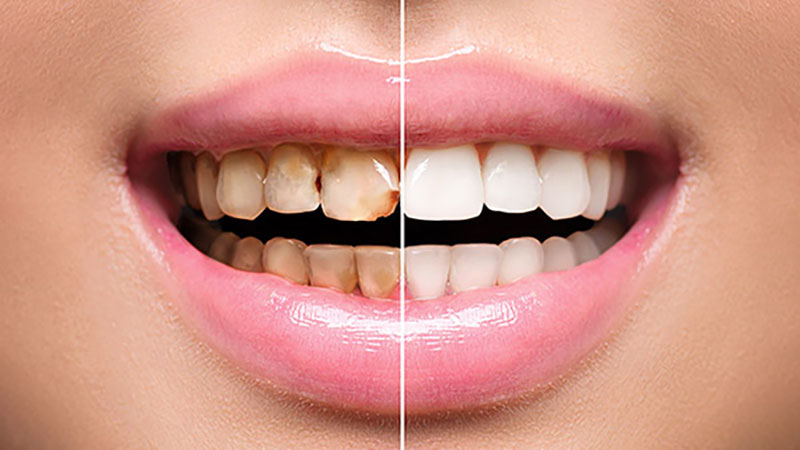 پوسیدگی دندان پس از لمینت دندان