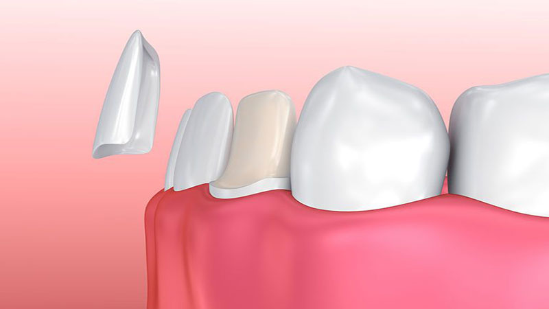 علت افتادن لمینت دندان