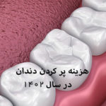 هزینه پر کردن دندان
