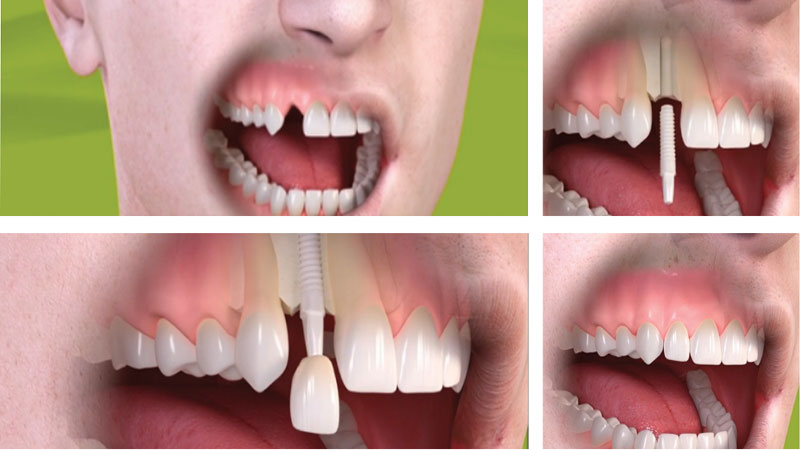 ایمپلنت دندان جلو چگونه است؟