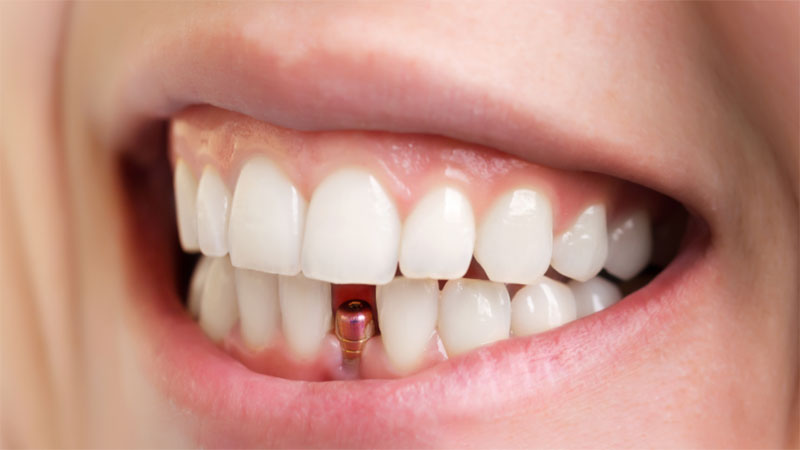 نصب پروتز یا تاج دندان
