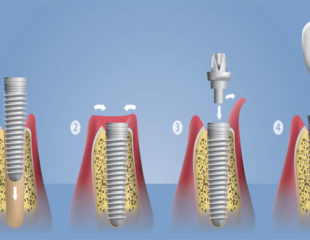 مراحل کاشت ایمپلنت