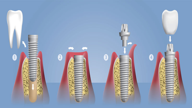 مراحل کاشت ایمپلنت